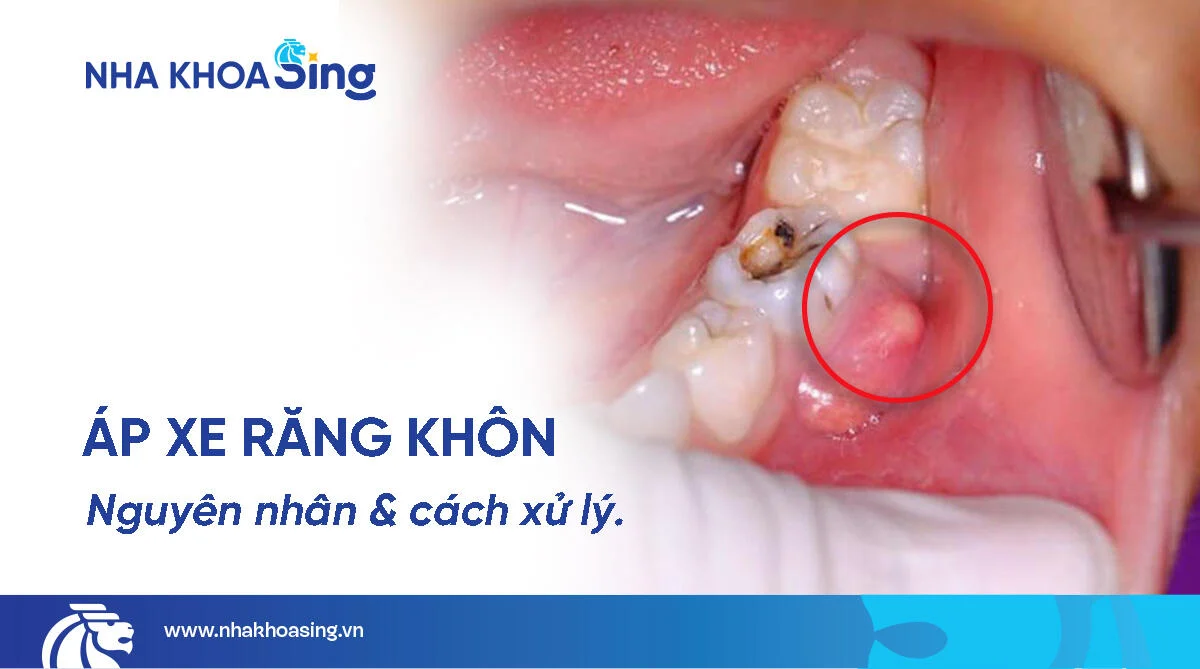 Kiến thức nha khoa Áp xe răng khôn: Dấu hiệu nhận biết và cách điều trị an toàn