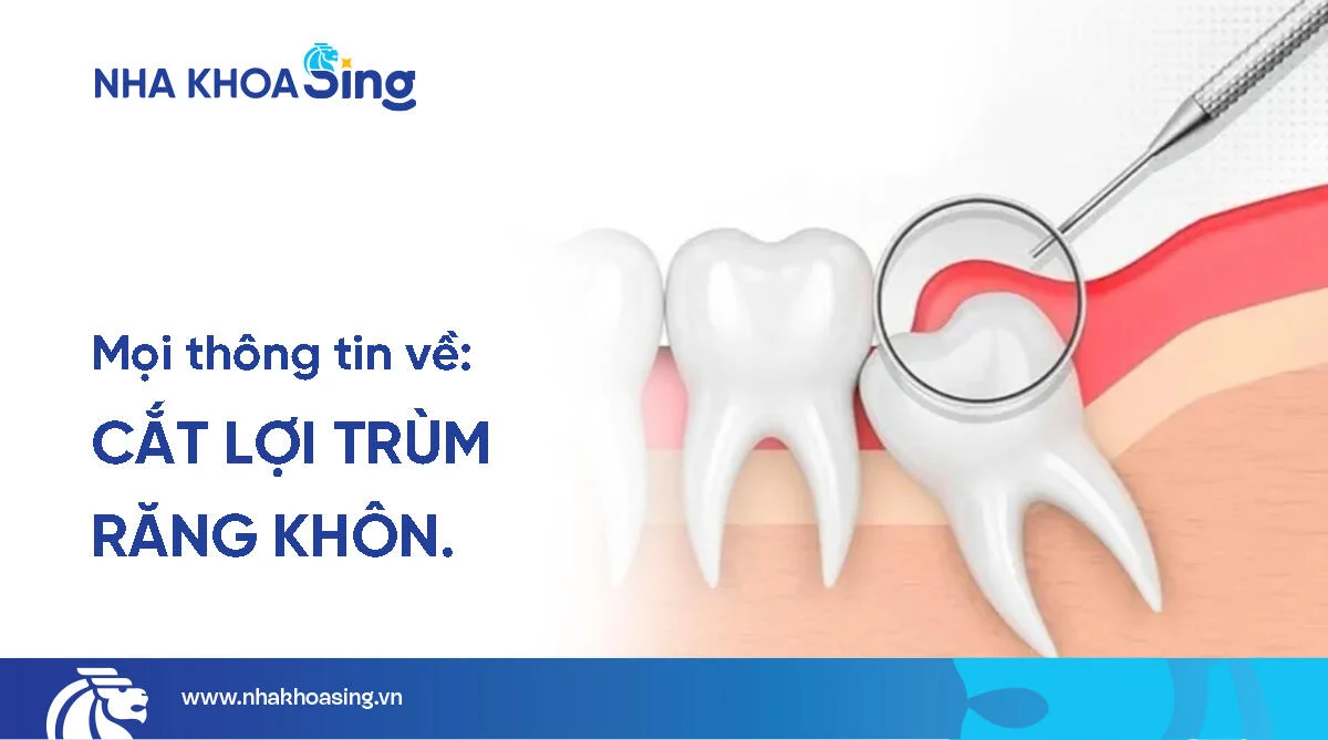 Cắt lợi trùm răng khôn: Có đau không? Bao lâu thì khỏi?