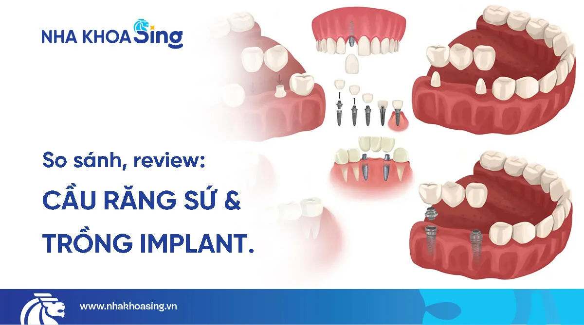 So sánh cầu răng sứ và implant: Đâu là lựa chọn tối ưu?