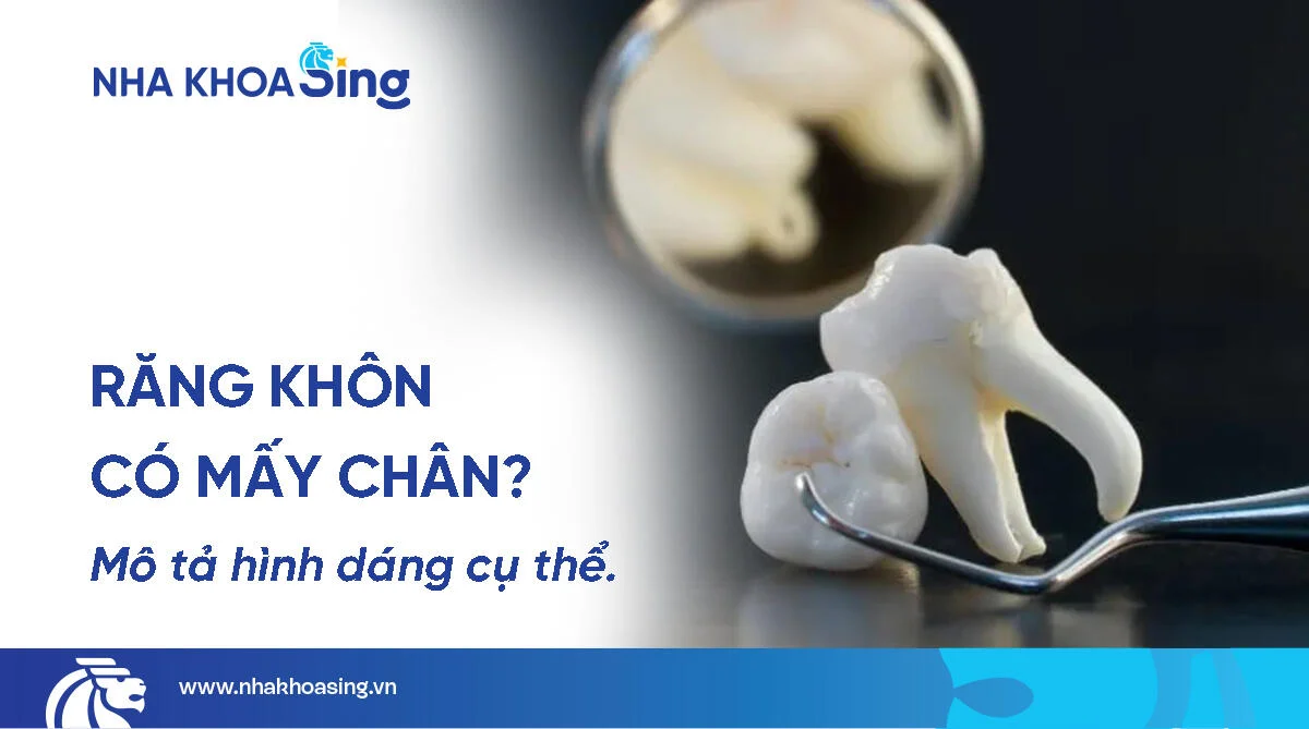 Kiến thức nha khoa Răng khôn có mấy chân? Những dạng chân răng khôn cần biết