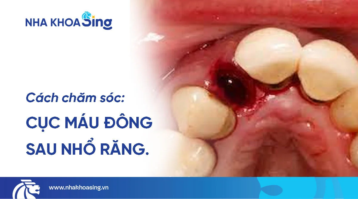 Cục máu đông sau khi nhổ răng: Nguyên nhân, vai trò và cách chăm sóc hiệu quả