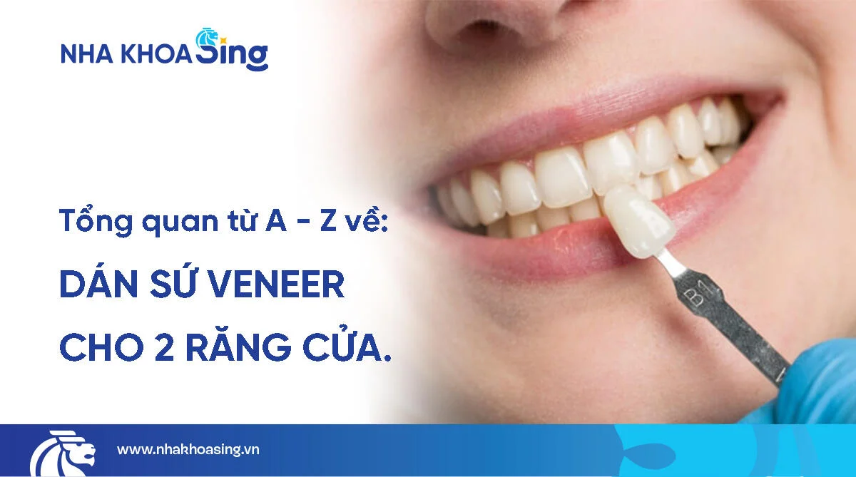 Dán sứ veneer 2 răng cửa giá bao nhiêu? Bảng giá mới 2025