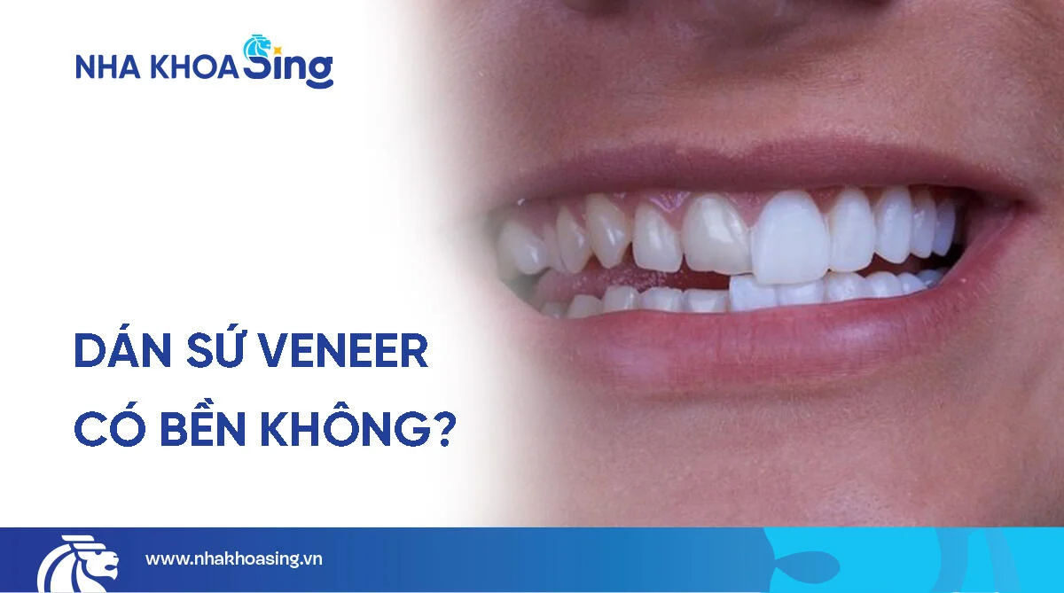 Dán sứ veneer có bền không? Được bao lâu?