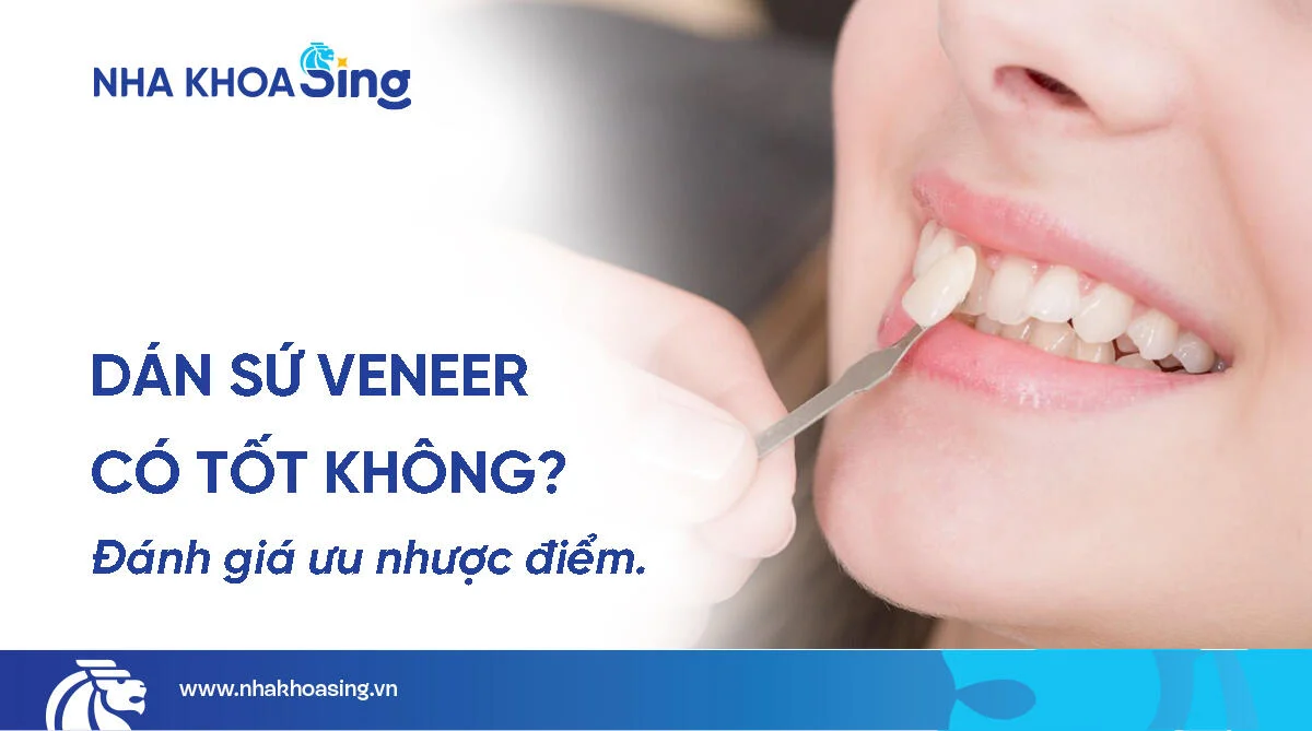 Dán sứ veneer có tốt không? Ưu nhược điểm của dán sứ veneer