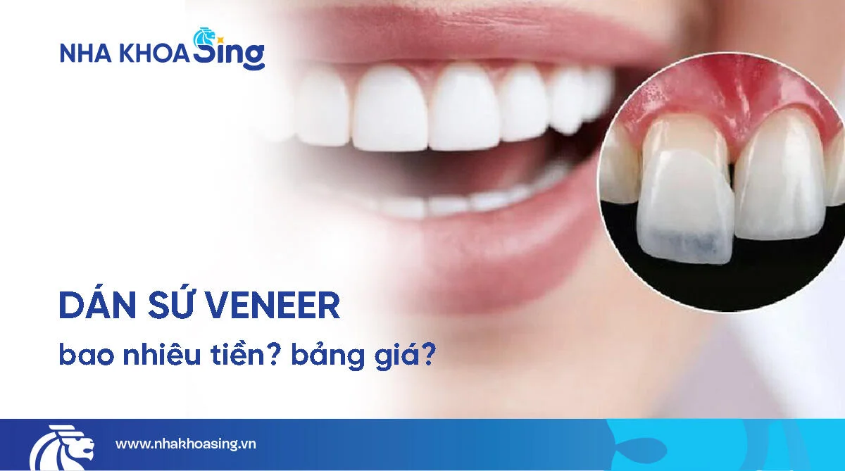 Dán sứ veneer giá bao nhiêu? Bảng giá mới nhất 2025