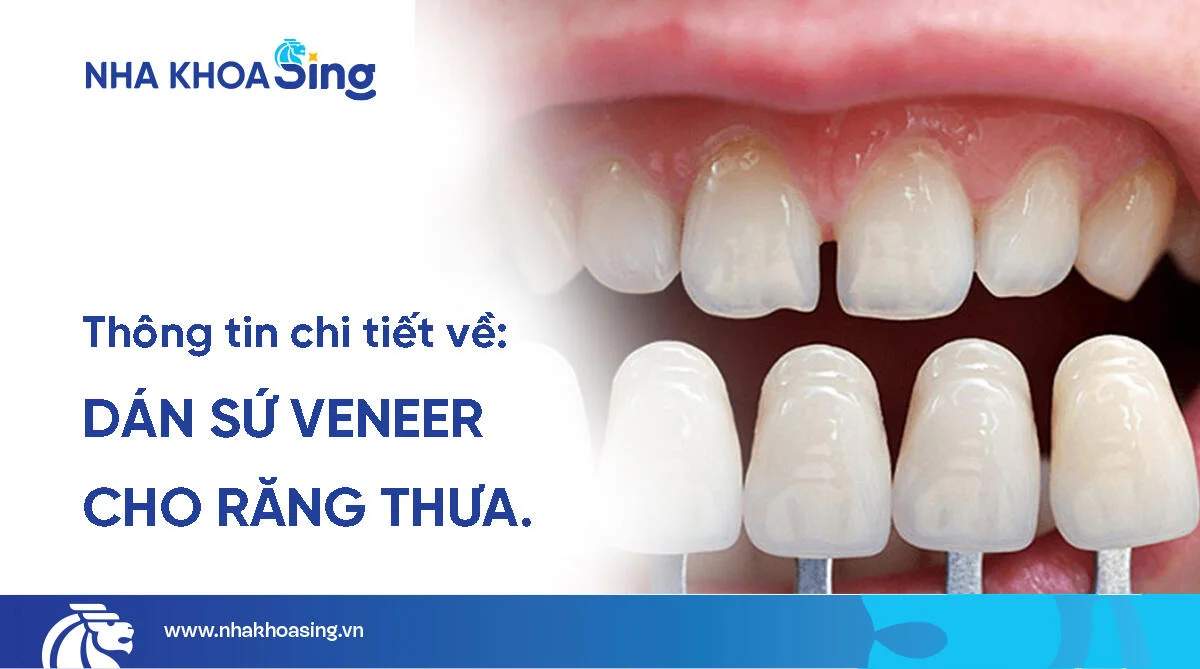 Dán veneer răng thưa: Trường hợp áp dụng, chi phí và lưu ý quan trọng