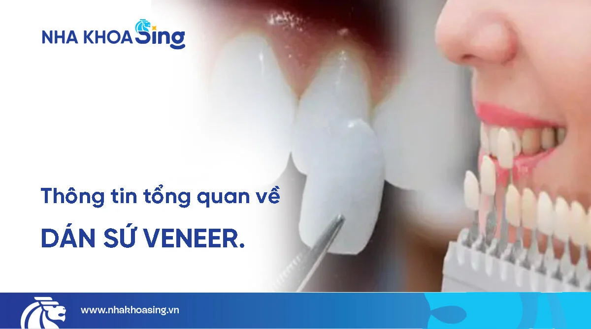 Dán sứ veneer là gì? Quy trình, chi phí và những lưu ý cần biết