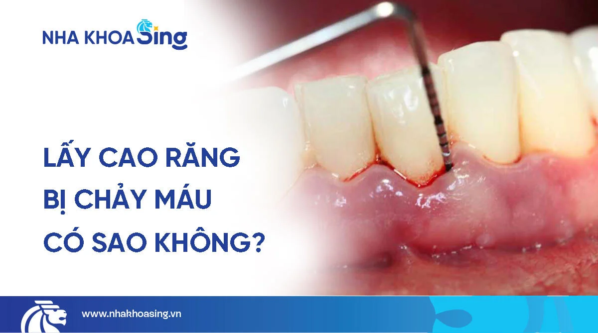Lấy cao răng bị chảy máu: Nguyên nhân, cách xử lý và phòng tránh
