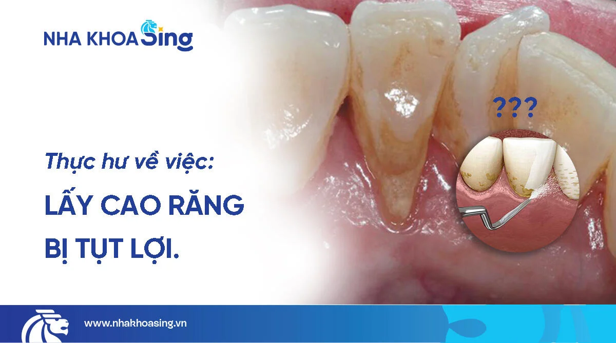Lấy cao răng xong bị tụt lợi có thật không? Thực hư ra sao?