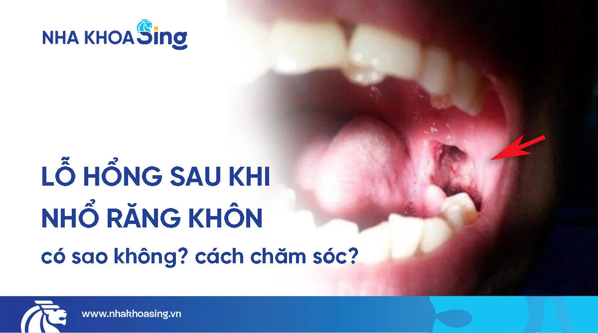 Lỗ sau khi nhổ răng khôn có nguy hiểm không? Cách xử lý nhanh lành