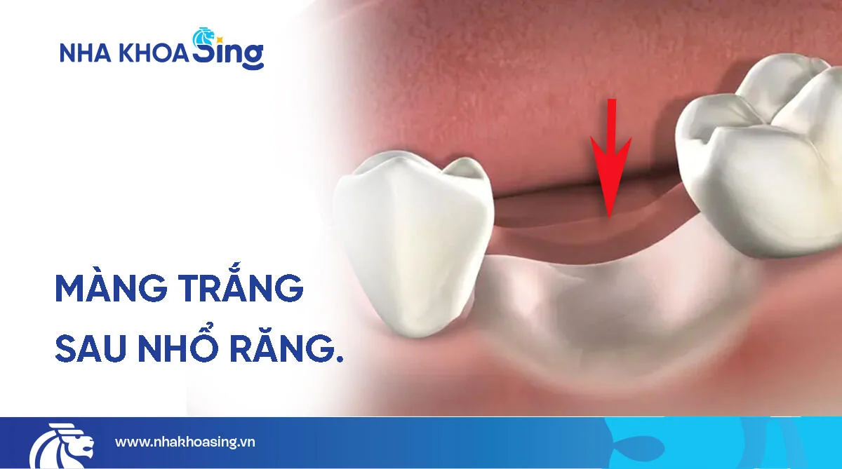 Màng trắng sau khi nhổ răng: Nguyên nhân và giải pháp