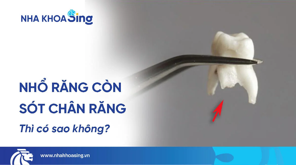 Nhổ Răng Còn Sót Chân Răng Có Sao Không? Những Điều Cần Biết