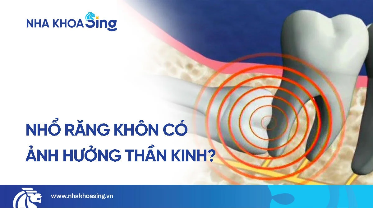 Nhổ răng khôn có ảnh hưởng đến thần kinh không? Giải đáp từ chuyên gia