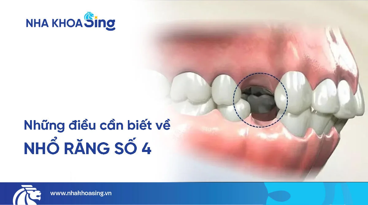 Nhổ răng số 4 có đau không, bao lâu lành, giá bao nhiêu?