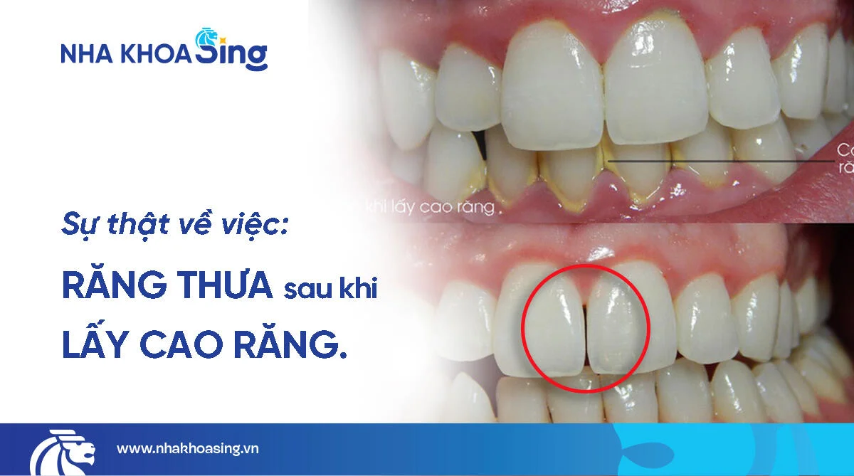 Răng bị thưa sau khi lấy cao răng có thật không?