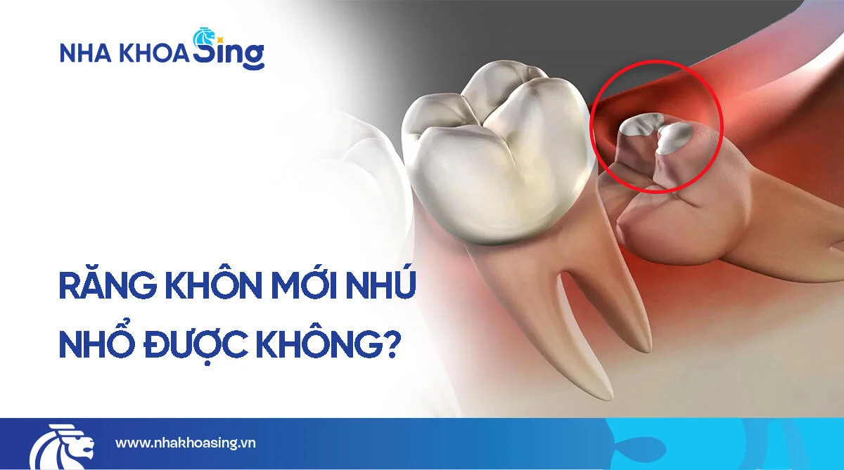 Răng khôn mới nhú có nhổ được không? Giải đáp chi tiết từ chuyên gia