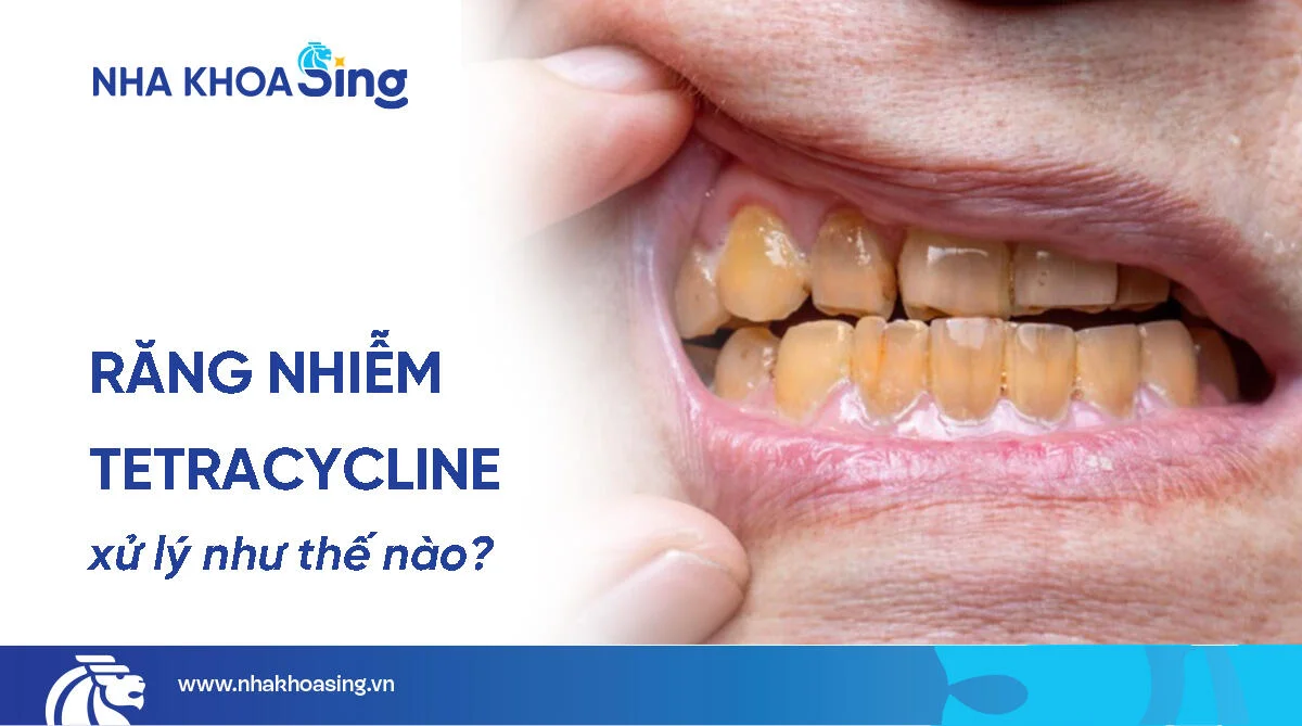 Răng nhiễm tetracycline: Nguyên nhân & cách điều trị hiệu quả