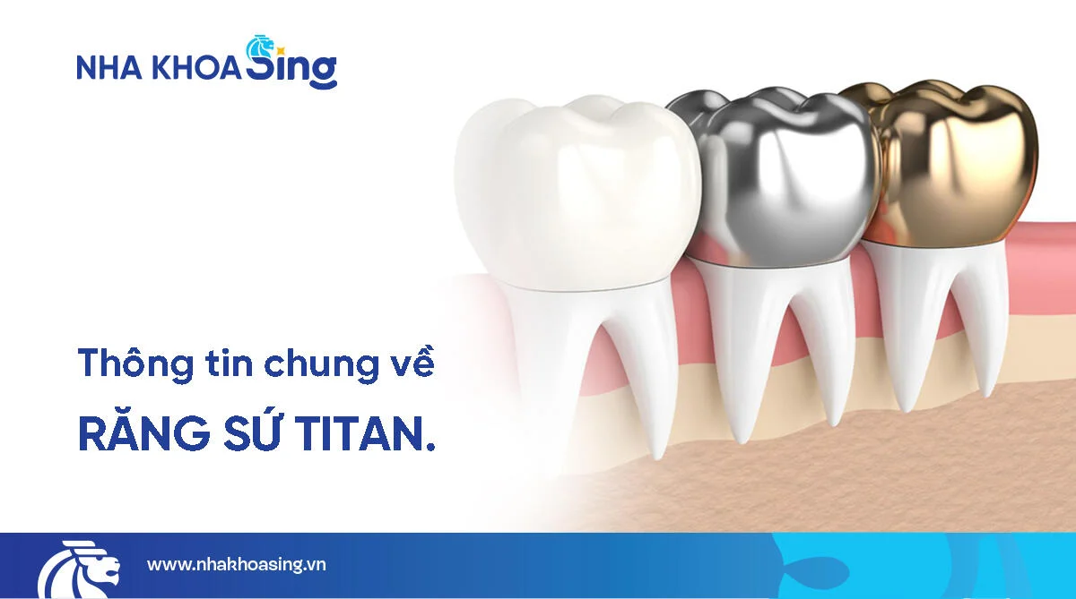 Răng sứ titan là gì? Giá răng sứ titan bao nhiêu? Đánh giá chi tiết?