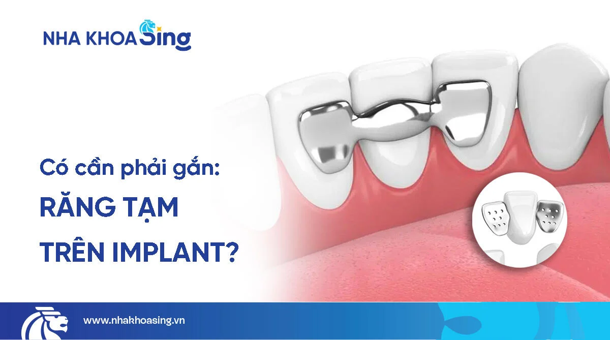 Răng tạm trên implant là gì? Có nên gắn không?