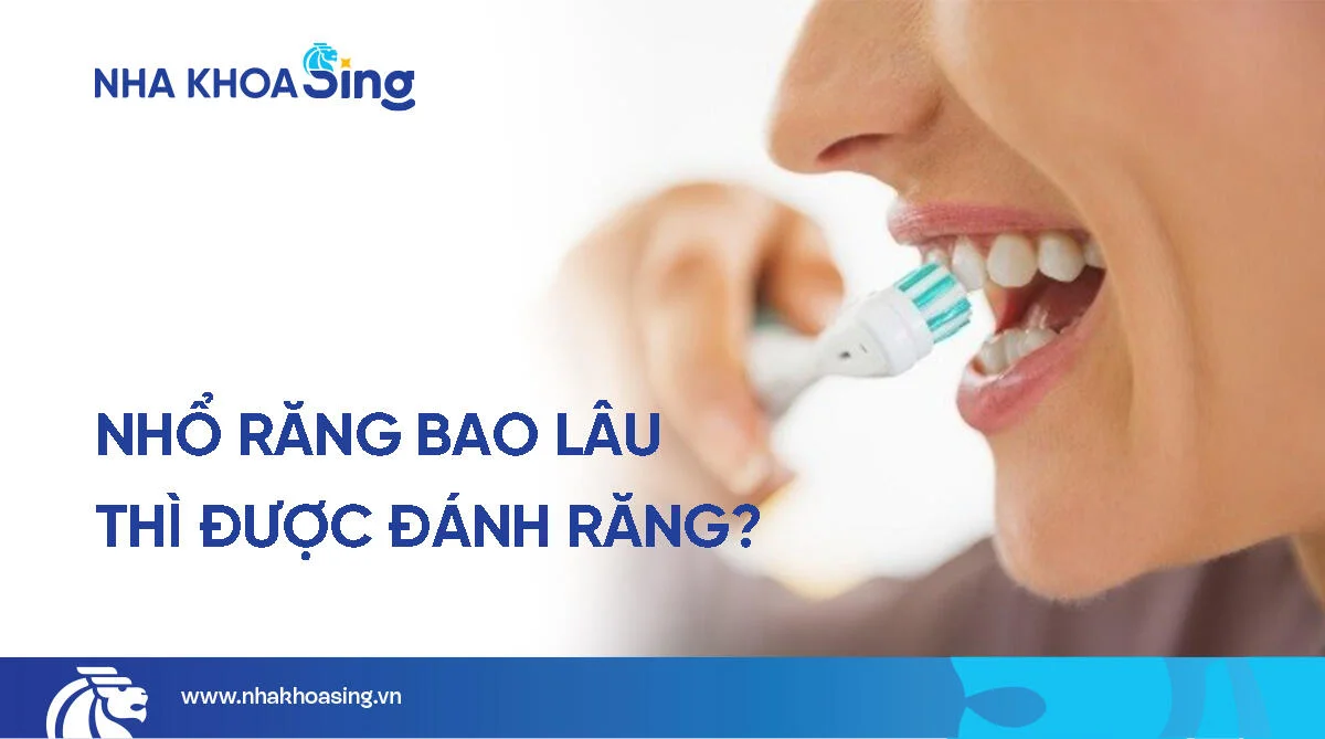 Sau khi nhổ răng bao lâu thì được đánh răng? Hướng dẫn vệ sinh sau nhổ răng