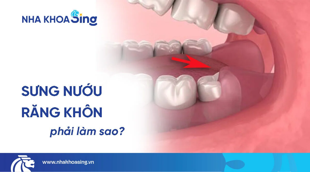 Kiến thức nha khoa Sưng nướu răng khôn: Nguyên nhân & cách điều trị dứt điểm