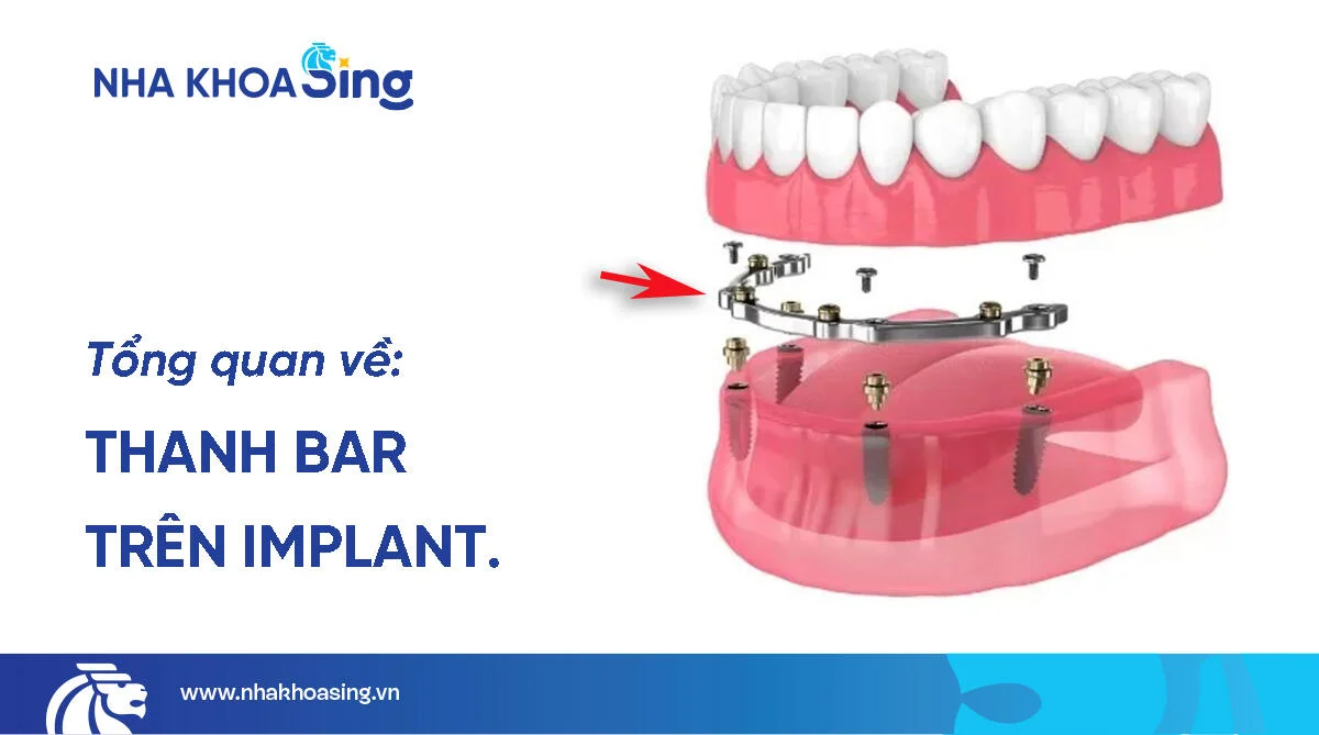 Thanh bar trên implant: Vai trò, quy trình và chi phí mới nhất