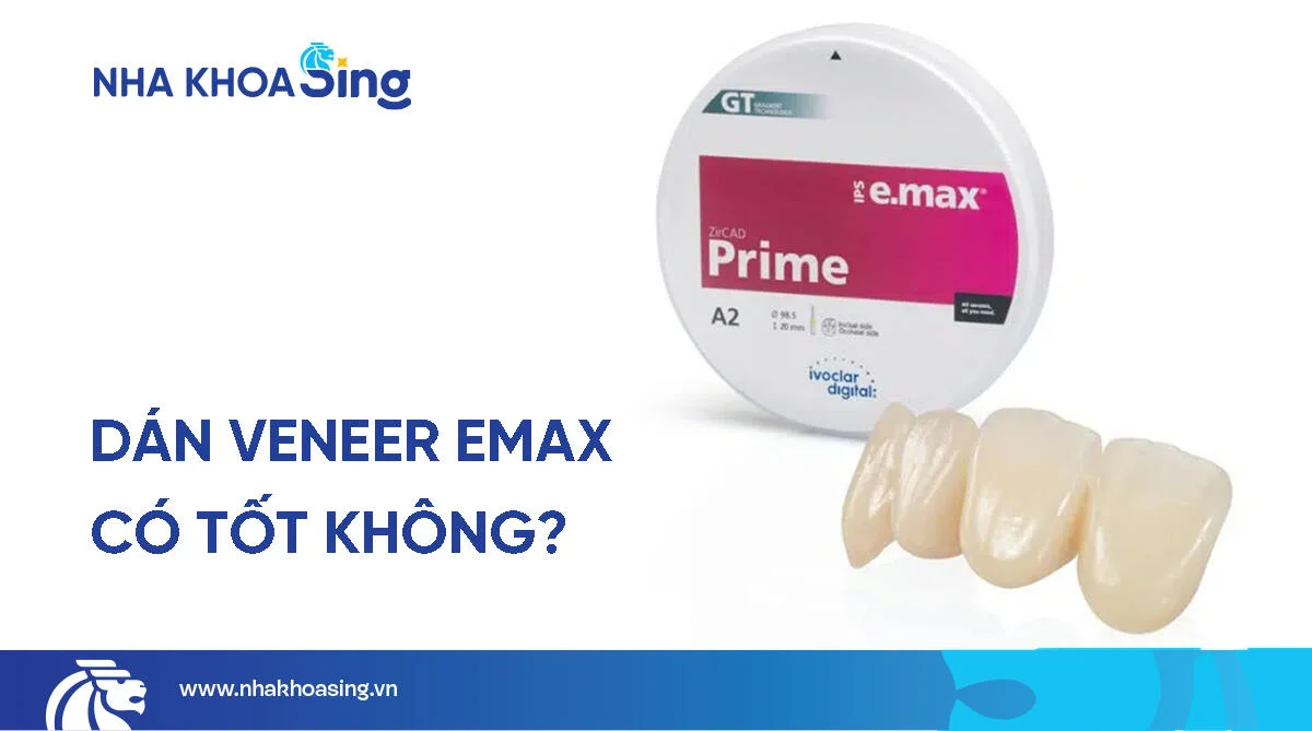 Veneer Emax là gì? Giá, ưu điểm & quy trình dán sứ chi tiết