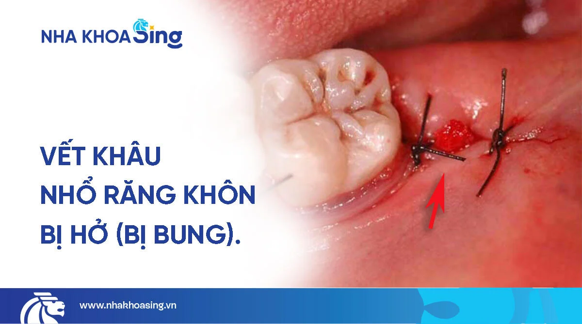 Vết khâu nhổ răng khôn bị hở nguy hiểm không? Cách xử lý an toàn