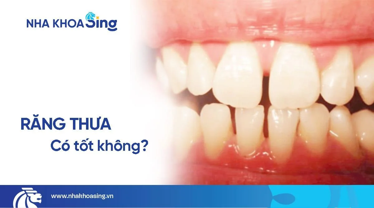 Răng thưa có tốt không? Giải pháp khắc phục răng cửa thưa thẩm mỹ nhất