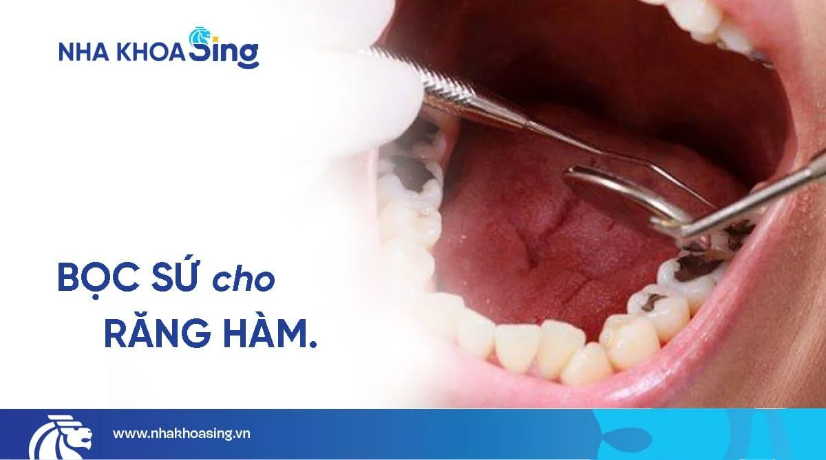 Tổng hợp thông tin về bọc sứ cho răng hàm: Những điều cần lưu ý
