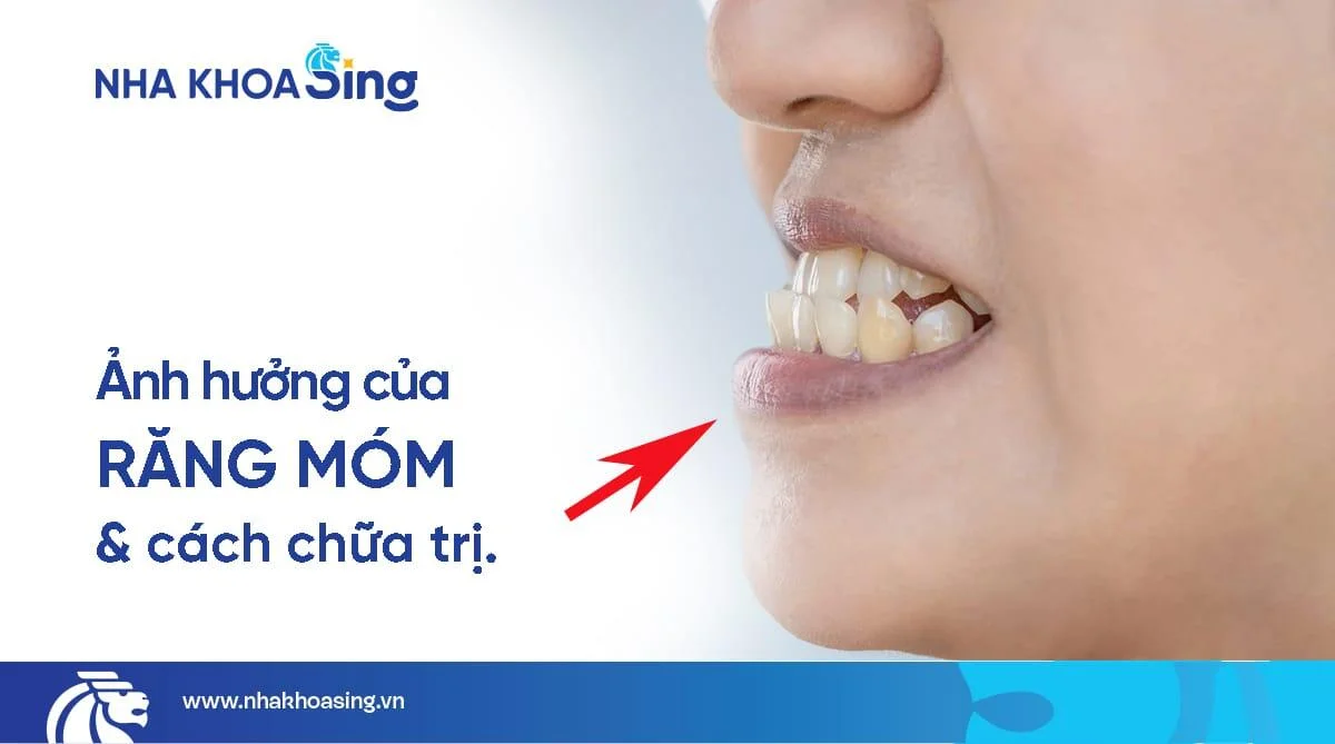 Răng móm có ảnh hưởng gì không? Cách hết móm hiệu quả