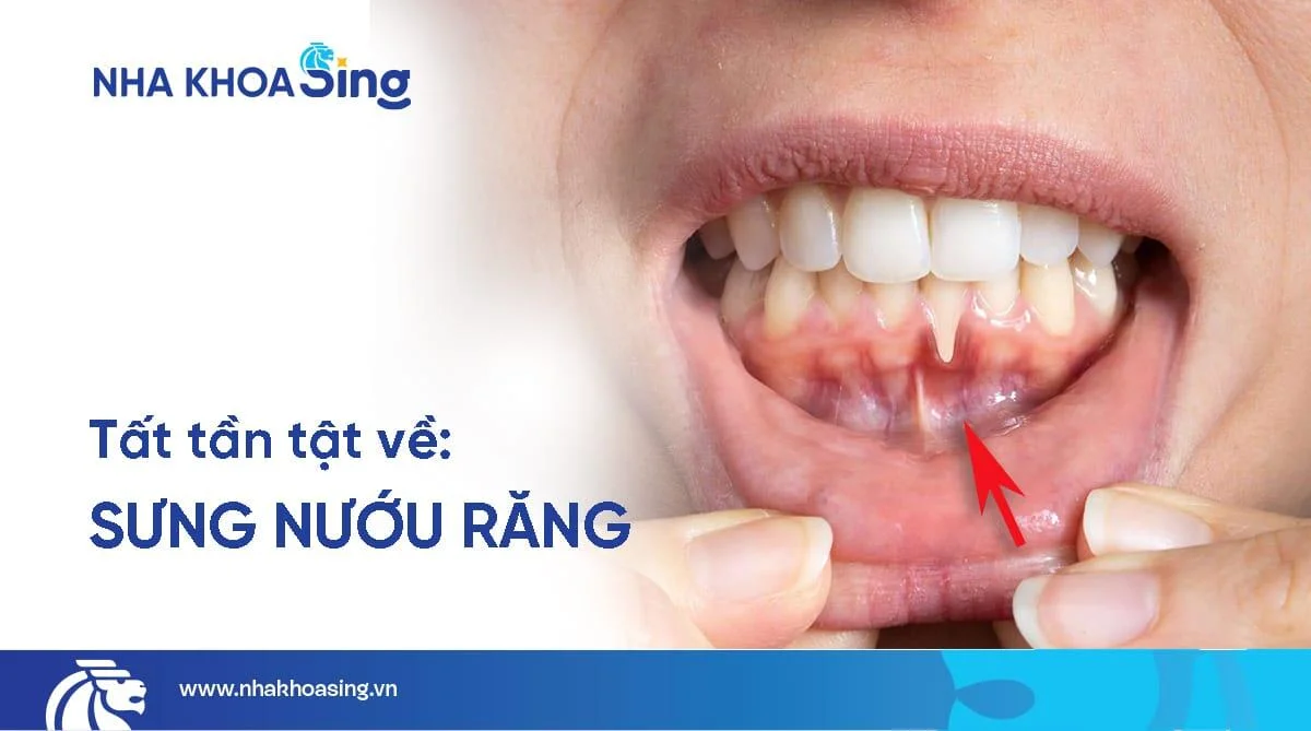 Sưng nướu răng: Triệu chứng, nguyên nhân & cách điều trị dứt điểm