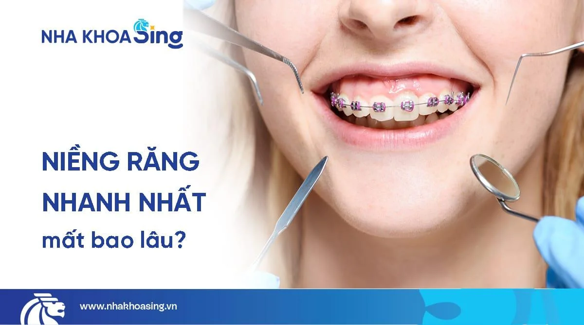 [Giải đáp] Niềng răng nhanh nhất bao lâu? Nên chọn loại niềng răng nào?