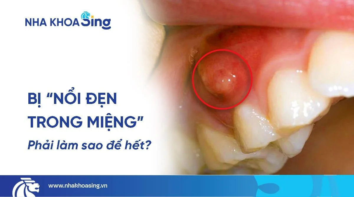 Nổi đẹn trong miệng: Nguyên nhân, triệu chứng và cách điều trị