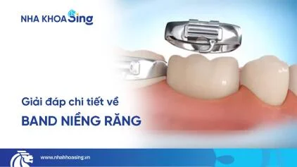 Band niềng răng là gì? Ai cần gắn khâu niềng răng?