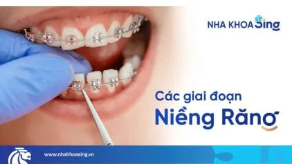 Các giai đoạn niềng răng chi tiết và sự thật ít ai chia sẻ