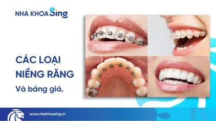 Các loại niềng răng hiện nay và bảng giá mới nhất 2025
