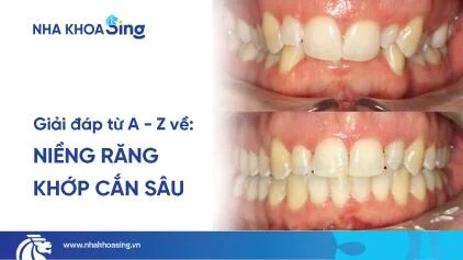 Niềng răng khớp cắn sâu: Quy trình, thời gian & lưu ý cần biết