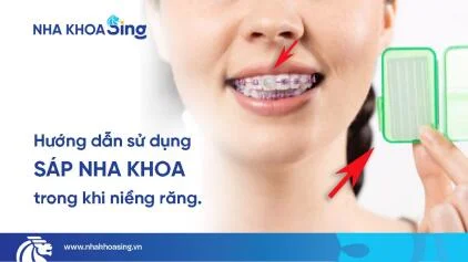 Sáp nha khoa là gì? Cách dùng, lưu ý và giải đáp khi niềng răng