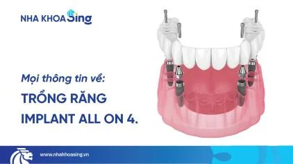 Trồng răng Implant All On 4: Lựa chọn tối ưu cho người mất răng toàn hàm