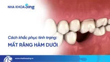 mat-rang-ham-duoi-thumbnail