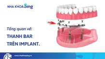 thanh-bar-tren-implant-thumbnail