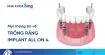 trong-rang-implant-all-on-4thumbnail