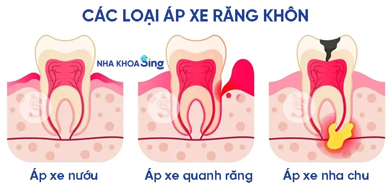 ap-xe-rang-khon-3