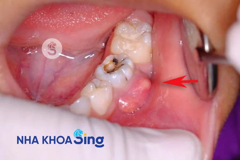 ap-xe-rang-khon