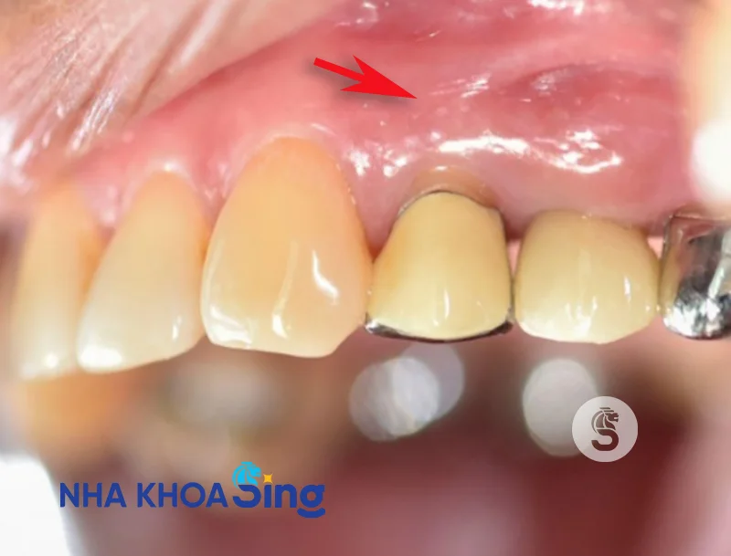 boc-rang-su-co-dau-khong-3