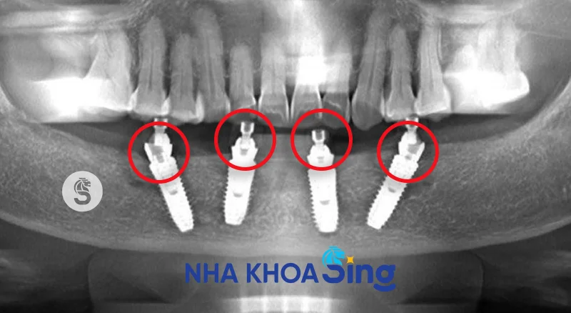 cam-implant-bi-lech-1