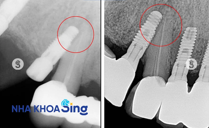 cam-implant-bi-lech-2