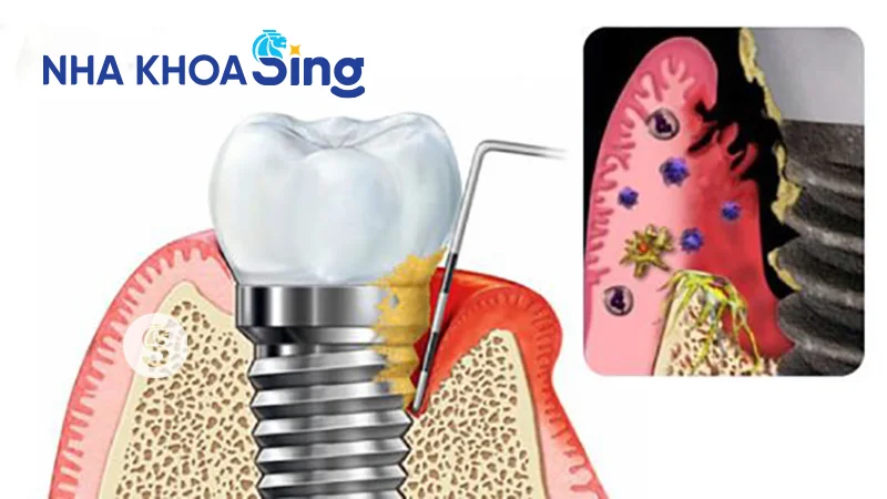 cam-implant-bi-lech-3