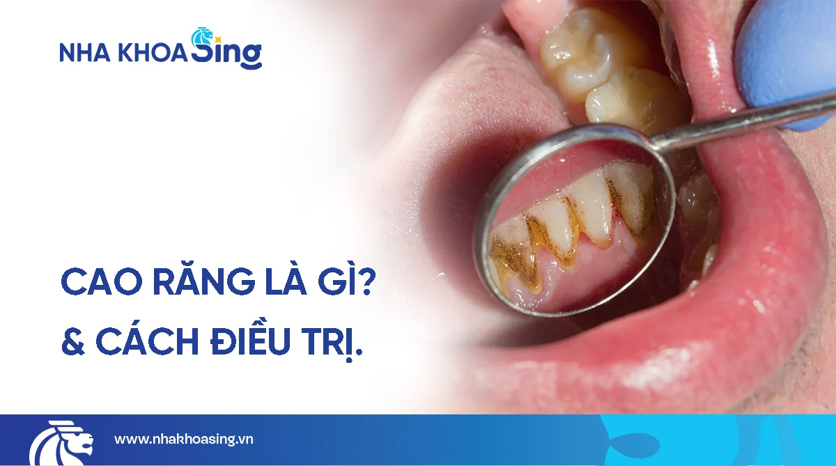Cao răng là gì? Nguy cơ tiềm ẩn và cách điều trị hiệu quả
